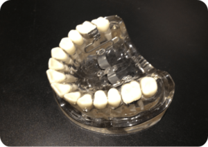 顎を広げる矯正